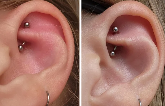 Can You Be Allergic to Piercings? Understanding Metal Sensitivities